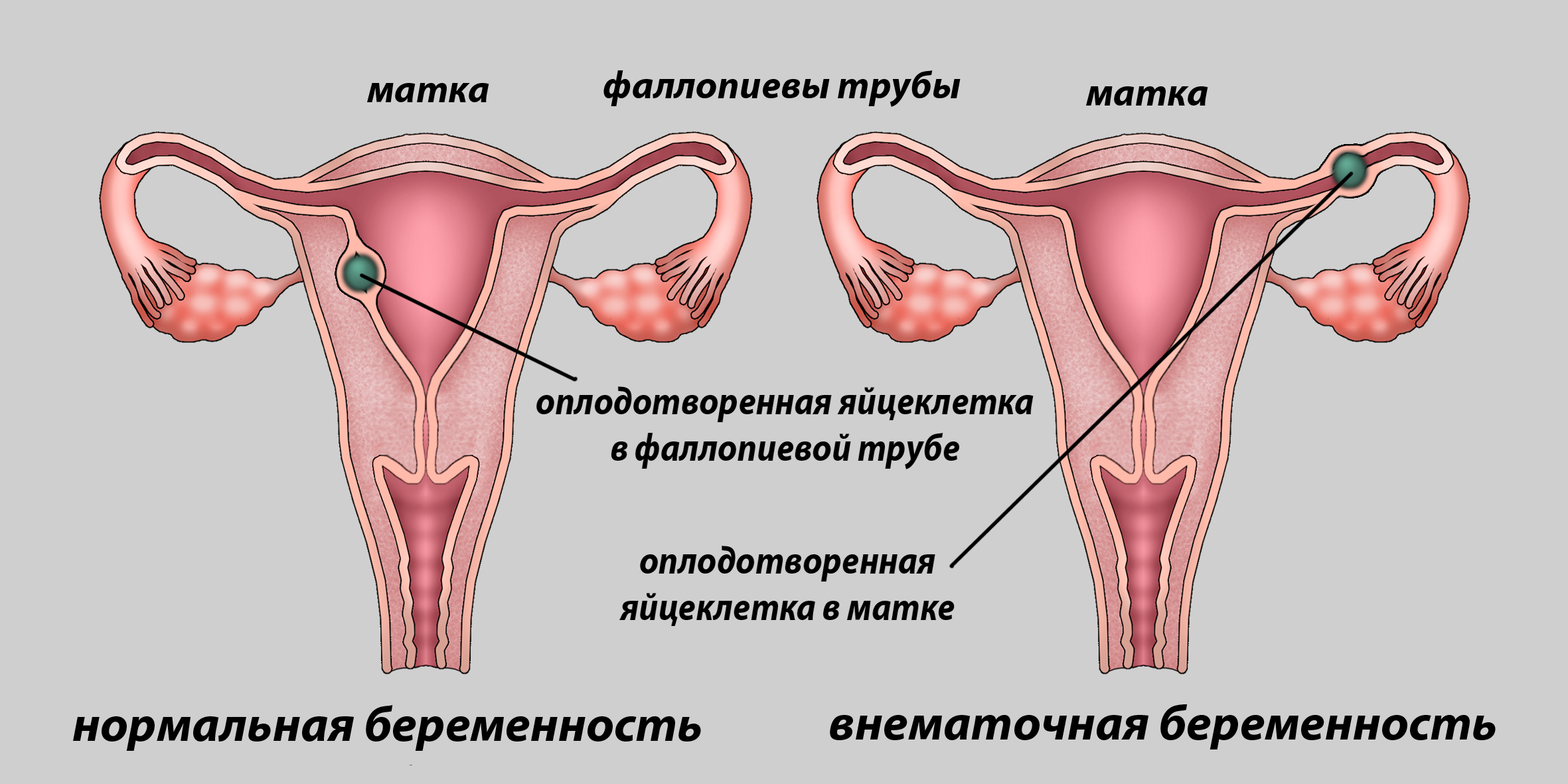 Боли в левом боку живота у женщин как выявить причину и вылечить недуг Внематочная беременность